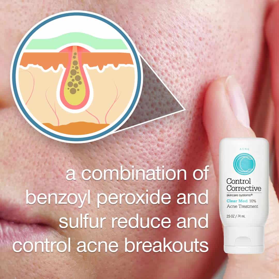 CONTROL CORRECTIVE Loción Tratamiento de Acné Clear Med - Imagen 6