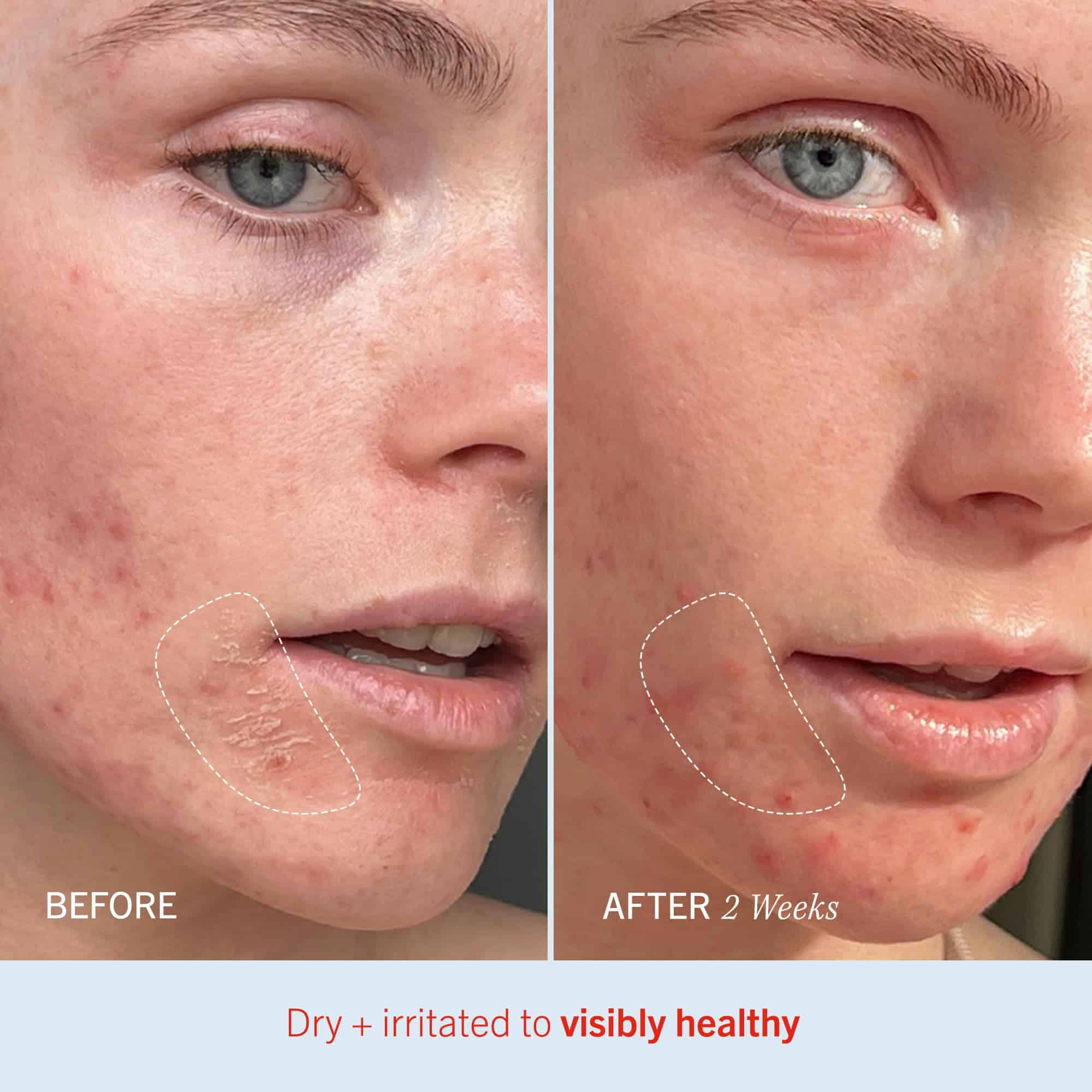 First Aid Beauty - Crema Ultra Reparadora, Hidratación - Imagen 6