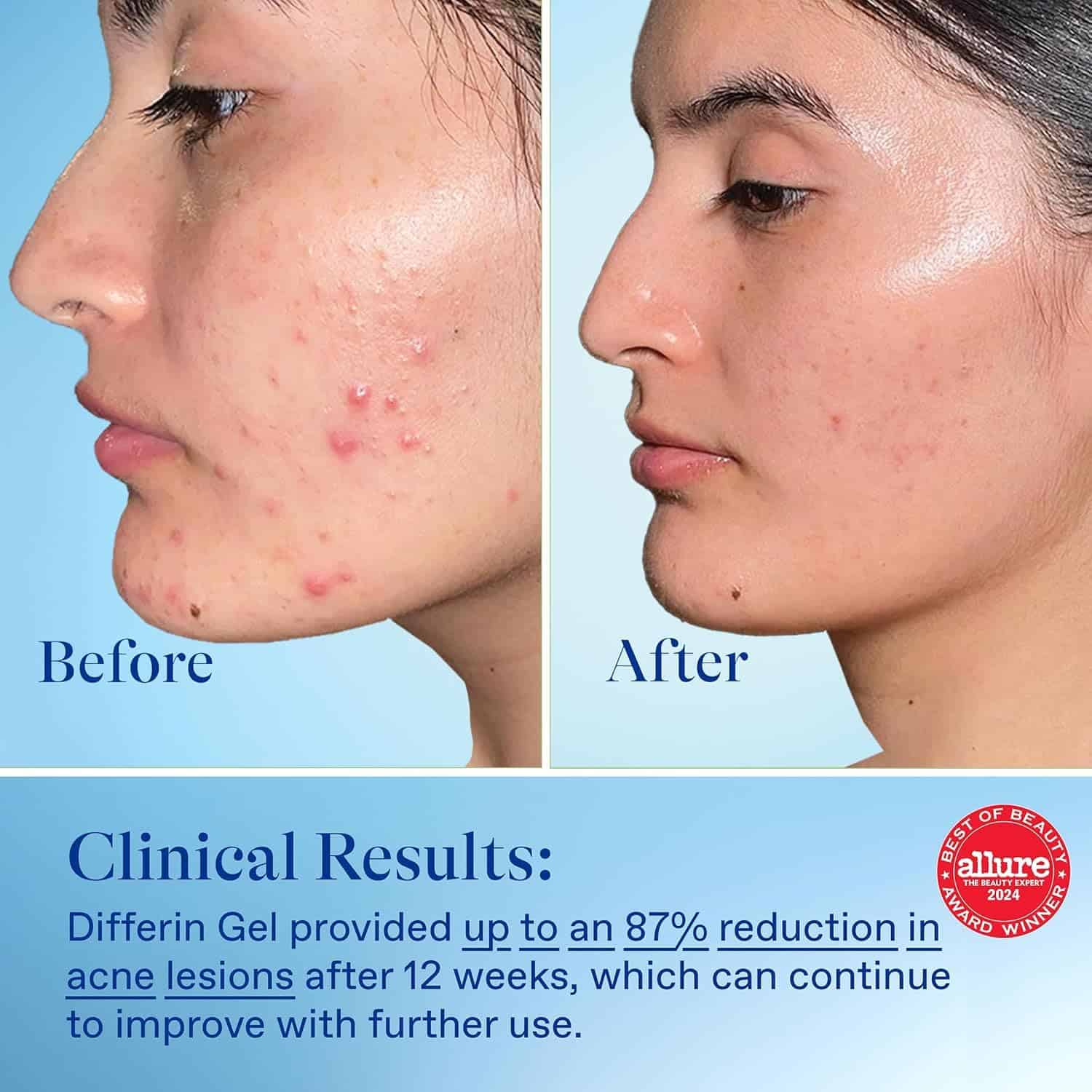 Gel de Tratamiento para el Acné Differin, Suministro de 180 - Imagen 9