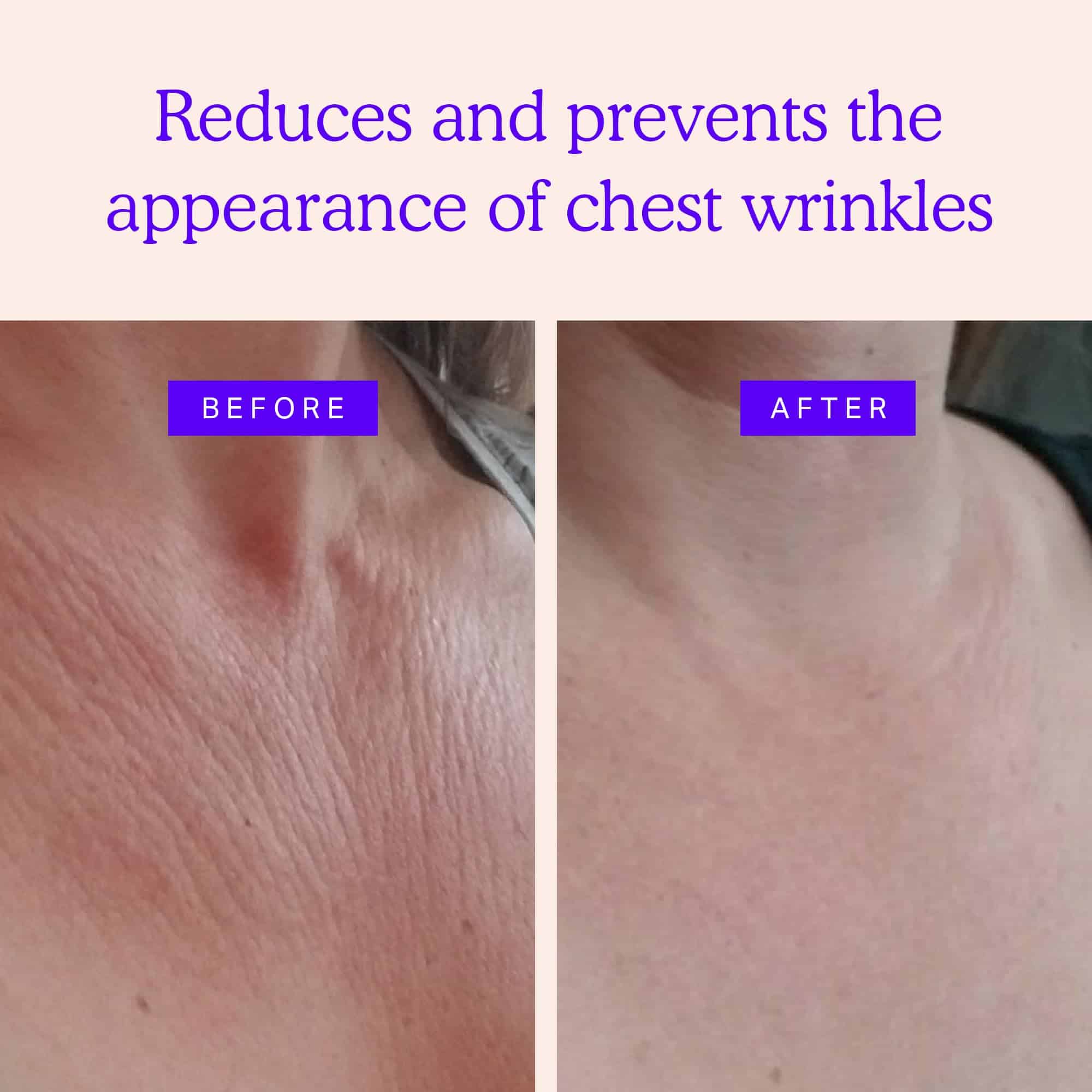 BLUMBODY Parches para Arrugas en el Pecho y Cuello � - Imagen 3