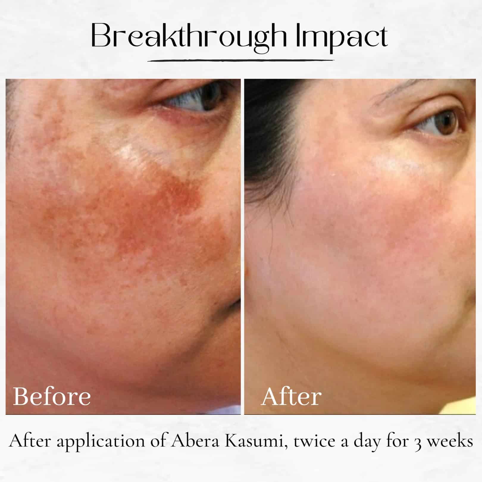 Crema ABERA Kasumi Melasma, Removedor de Manchas Oscuras - Imagen 6