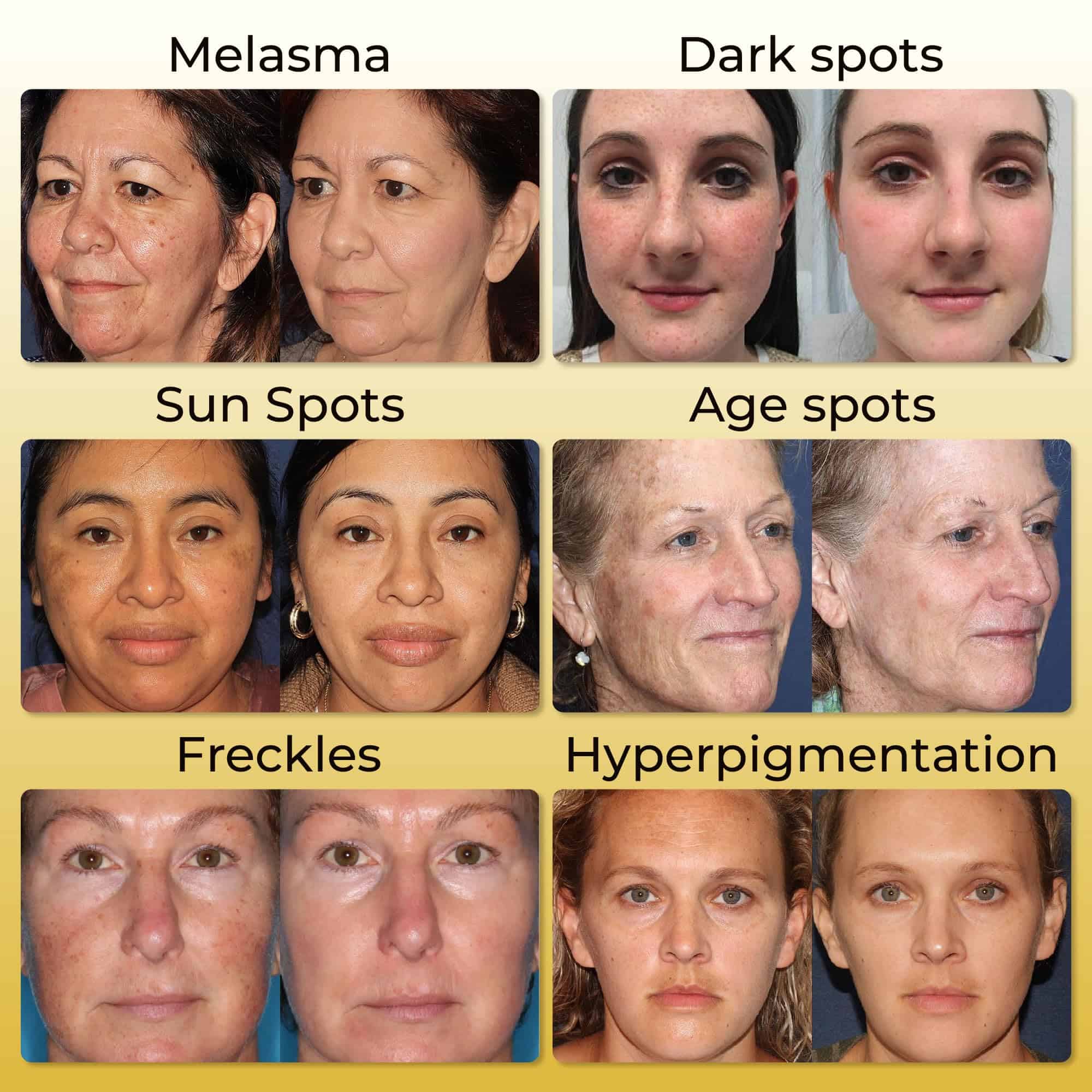 Crema ABERA Kasumi Melasma, Removedor de Manchas Oscuras - Imagen 4