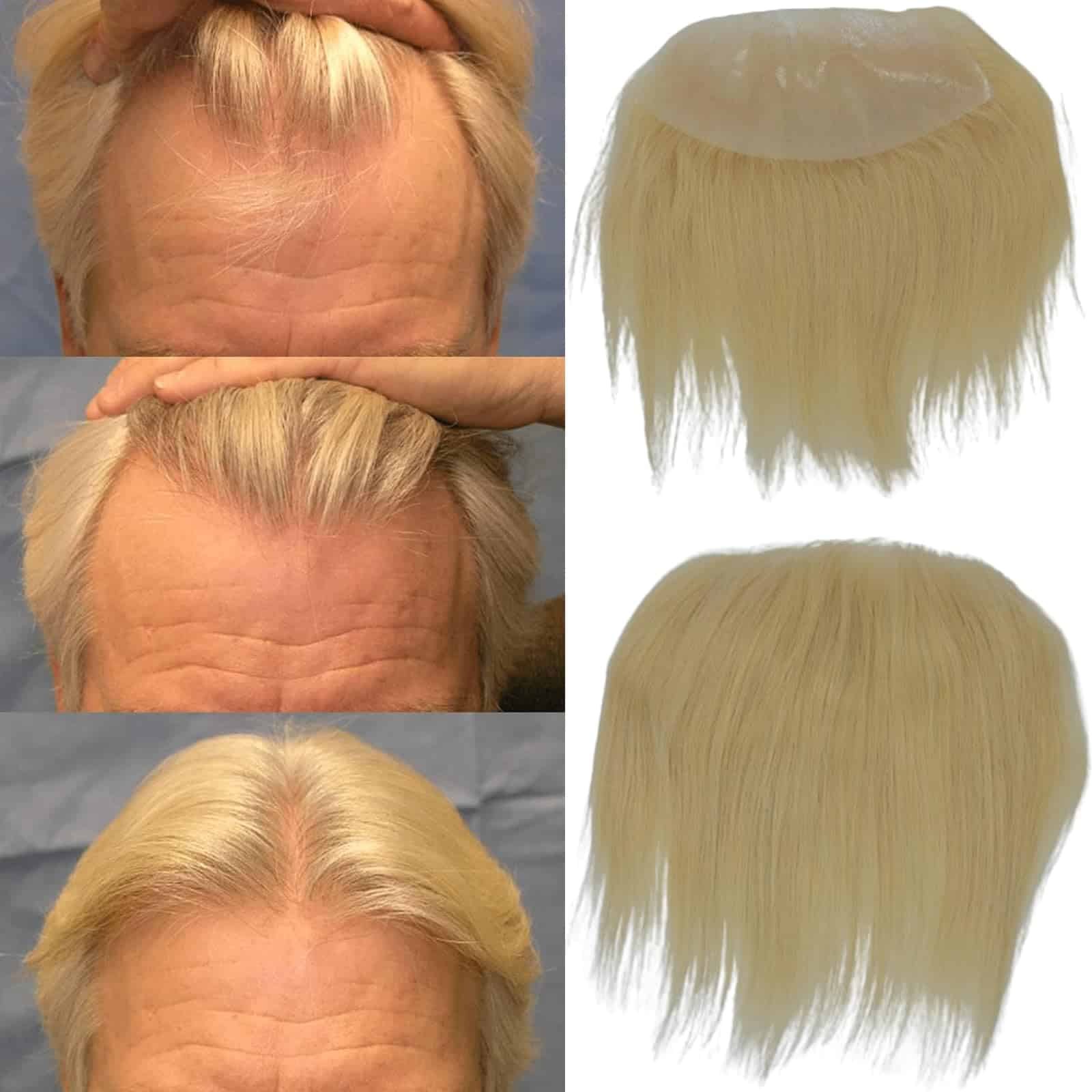 Toupé de Hombre Voloria para Línea del Cabello Frontal 100%