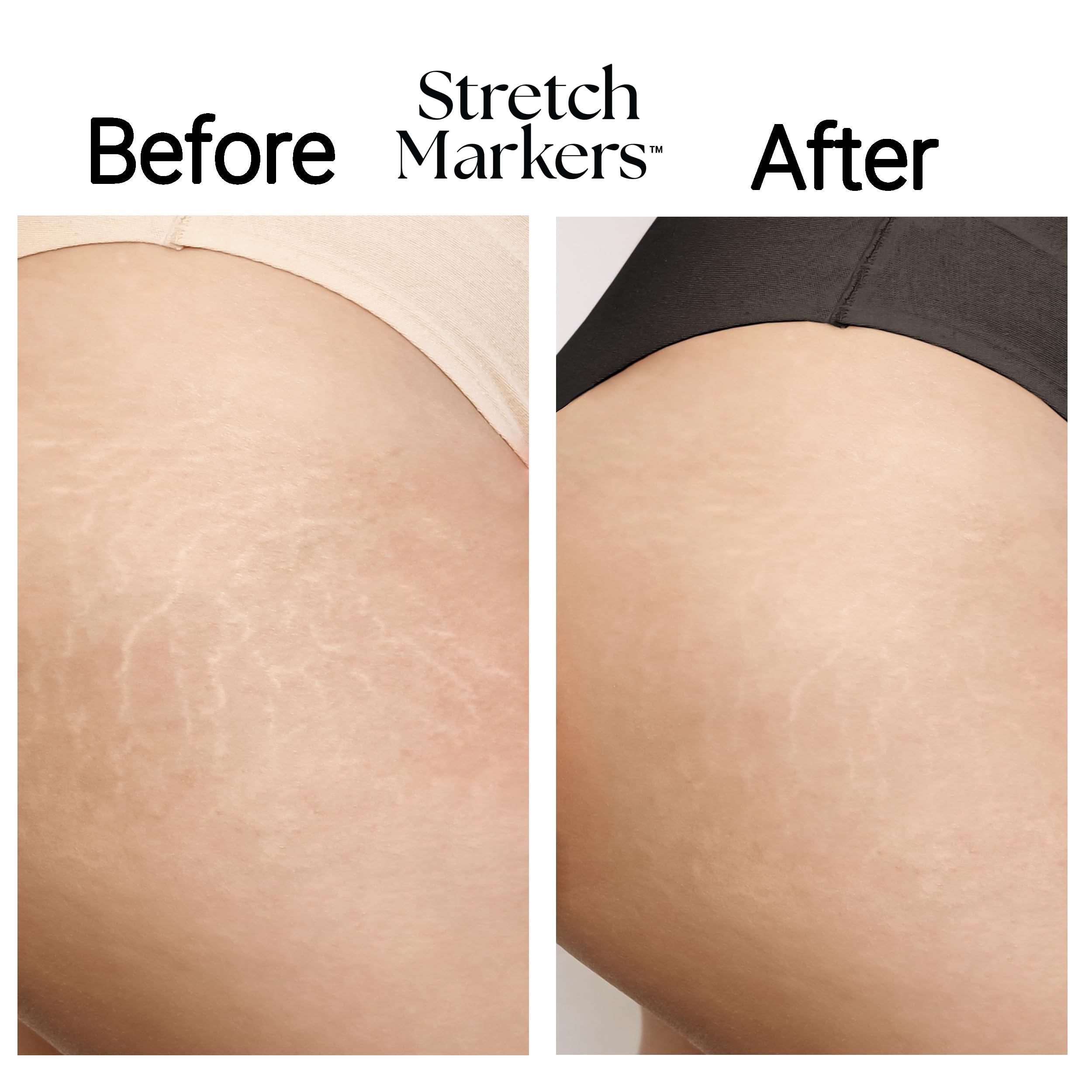 Crema StretchMarkers Pregnancy Defender: Previene, reduce - Imagen 6