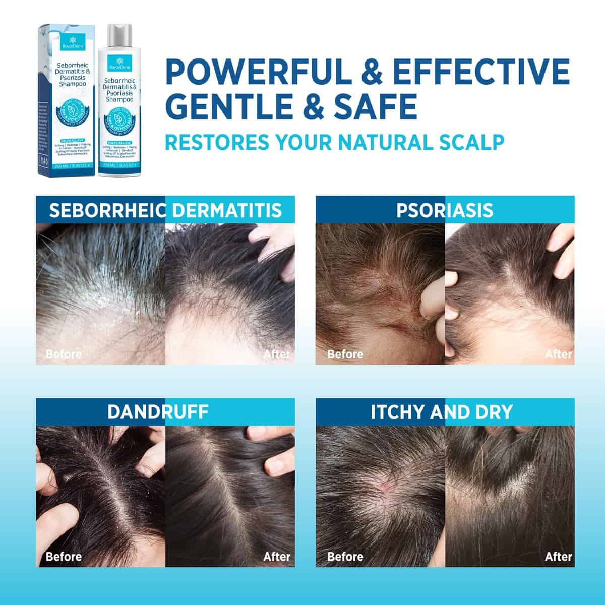 Champú para la Psoriasis Roycederm, Champú para la - Imagen 4