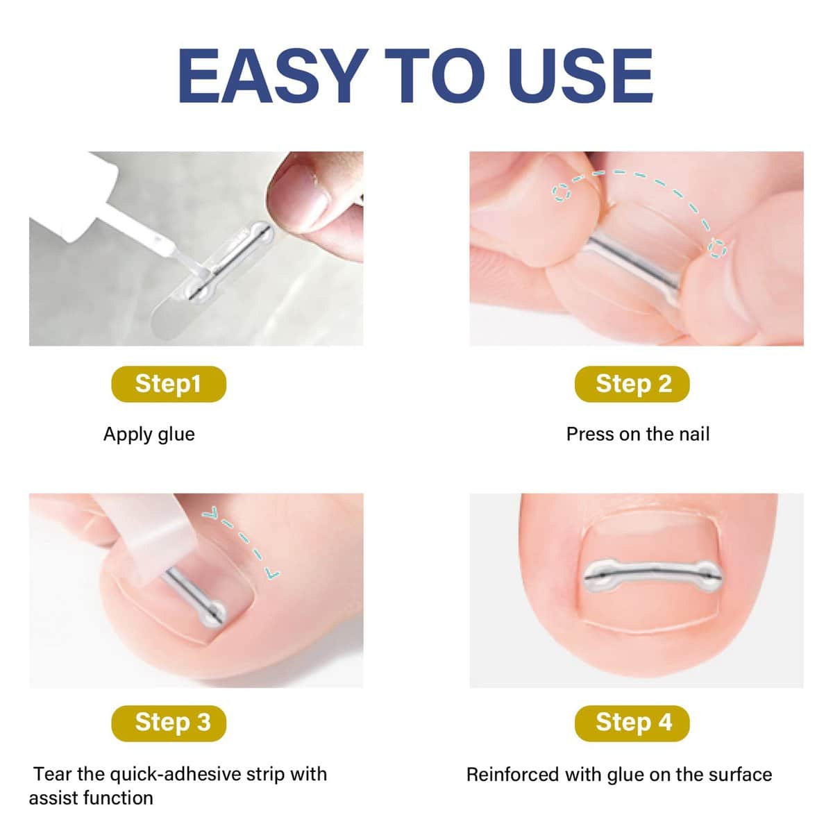 Kit de Tratamiento para Uñas Encarnadas, Kit Reutilizable - Imagen 9