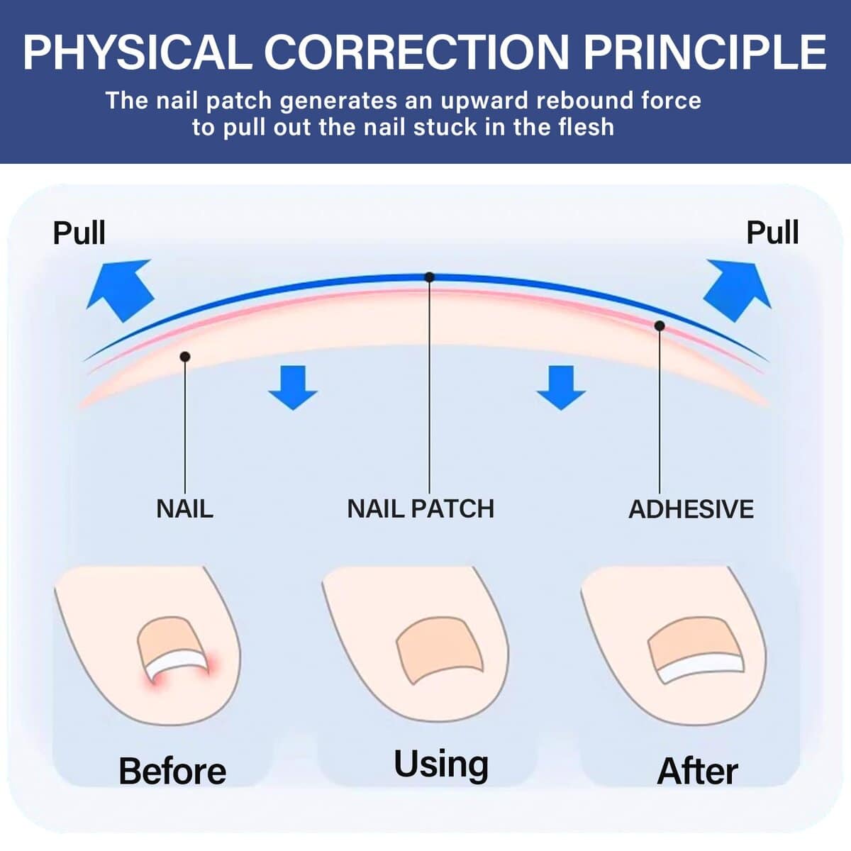 Kit de Tratamiento para Uñas Encarnadas, Kit Reutilizable - Imagen 8