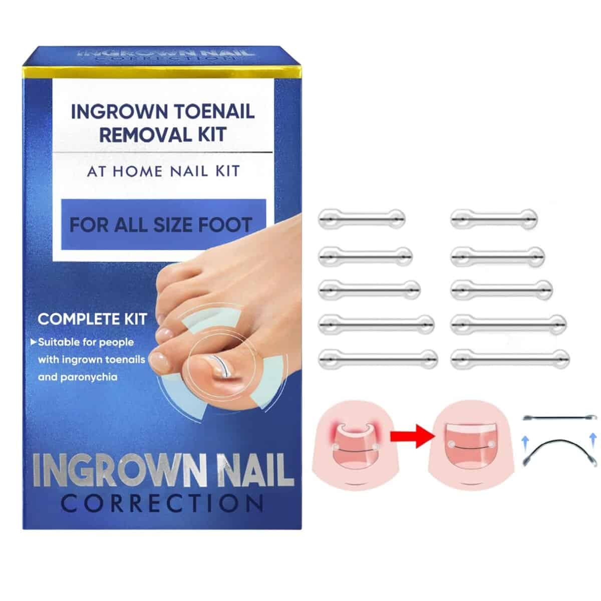 Kit de Tratamiento para Uñas Encarnadas, Kit Reutilizable